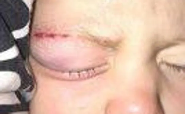 Un bebé termina con el párpado pegado tras acudir al hospital por un corte cerca del ojo
