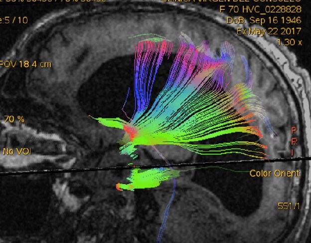 El Servicio de NeuroRehabilitación obtiene la prestigiosa ayuda europea Marie Sklodowska-Curie para investigar sobre el daño cerebral