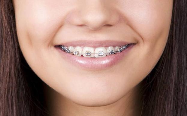 Odontólogos valencianos investigan nuevos materiales para prevenir las manchas blancas en los dientes con brackets