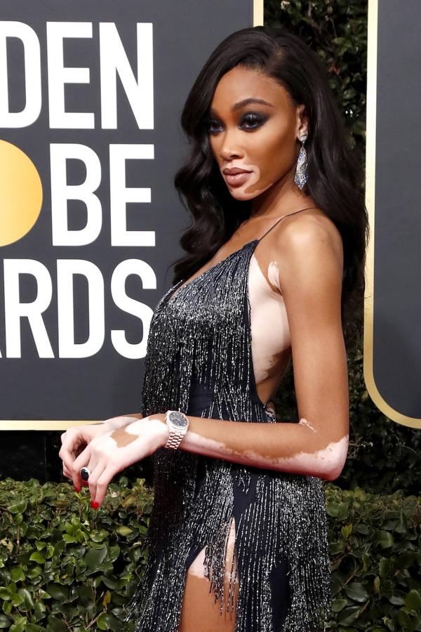 La modelo canadiense Winnie Harlow. 