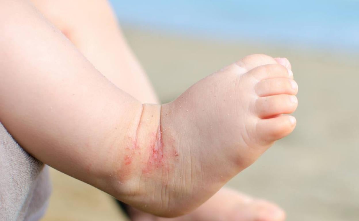 Investigan la ciclosporina A para tratar la psoriasis y la dermatitis atópica