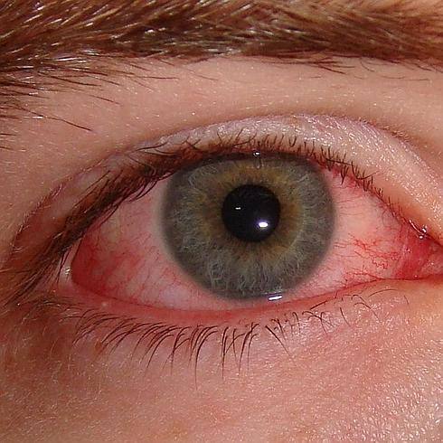 La conjuntivitis, otro posible síntoma del coronavirus