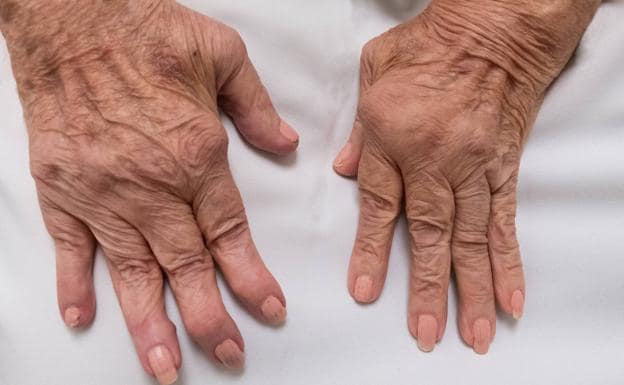 La artritis reumatoide produce una deformidad progresiva de las articulaciones y la reducción de la movilidad articular