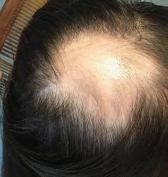 Alopecia arerata.