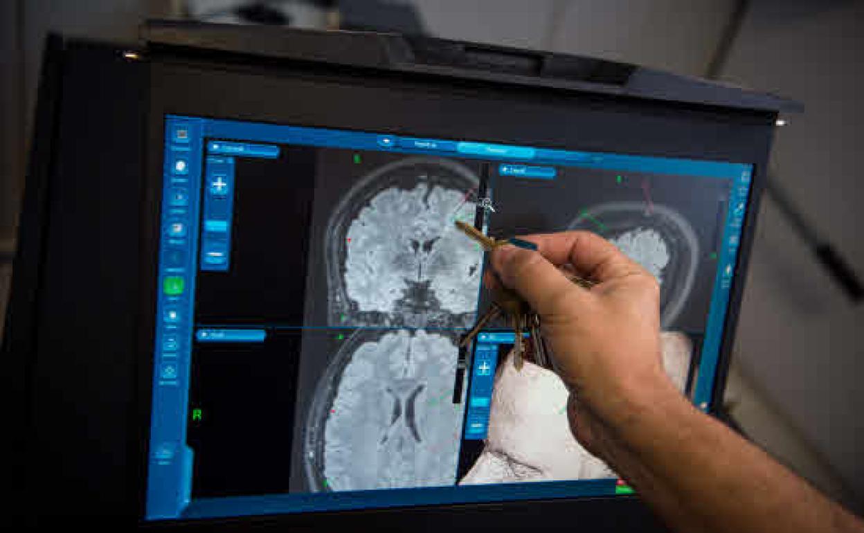 Operación de cerebro a paciente con epilepsia consciente en el hospital de Cruces.