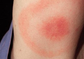 Enfermedad de Lyme: síntomas y cómo prevenir las picaduras de garrapata