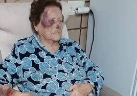 La anciana agredida con moratones en la cara y el brazo derecho.
