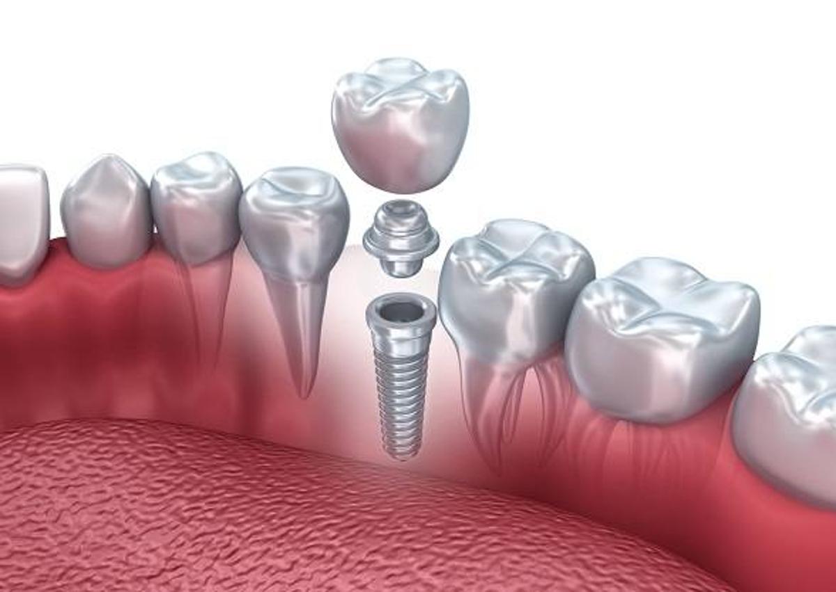Imagen secundaria 1 - Clínica Dental Reverte