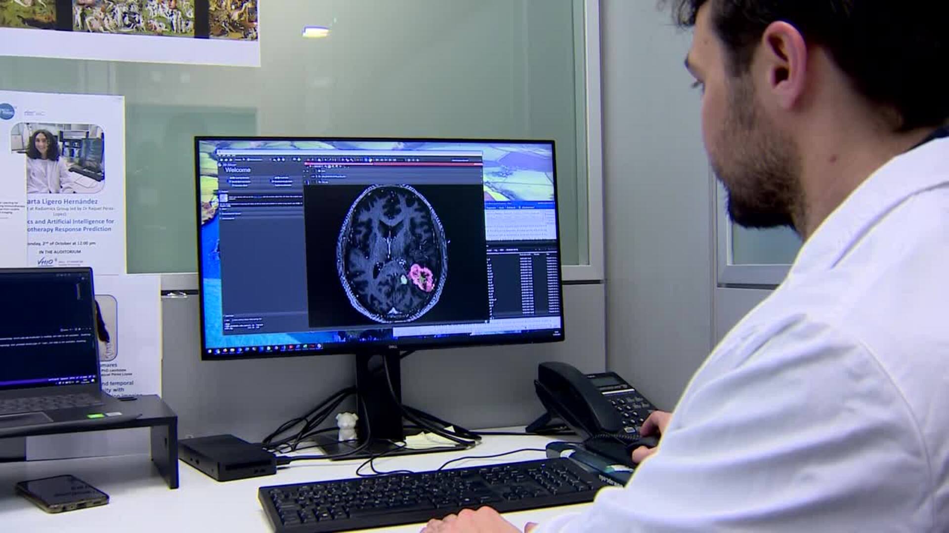La herramienta IA DISCERN evita la realización de biopsias para detectar tumores cerebrales