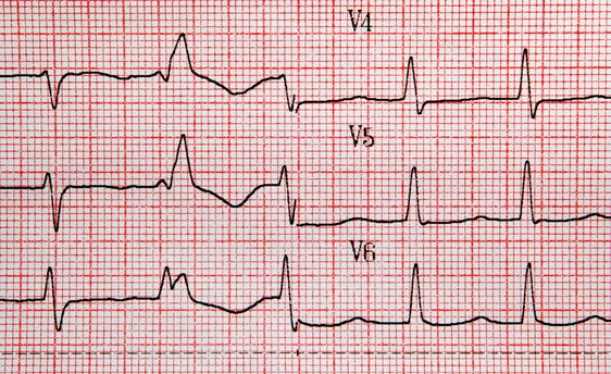 Un electrocardiograma, en una imagen de archivo.