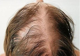 Una persona afectada por alopecia.