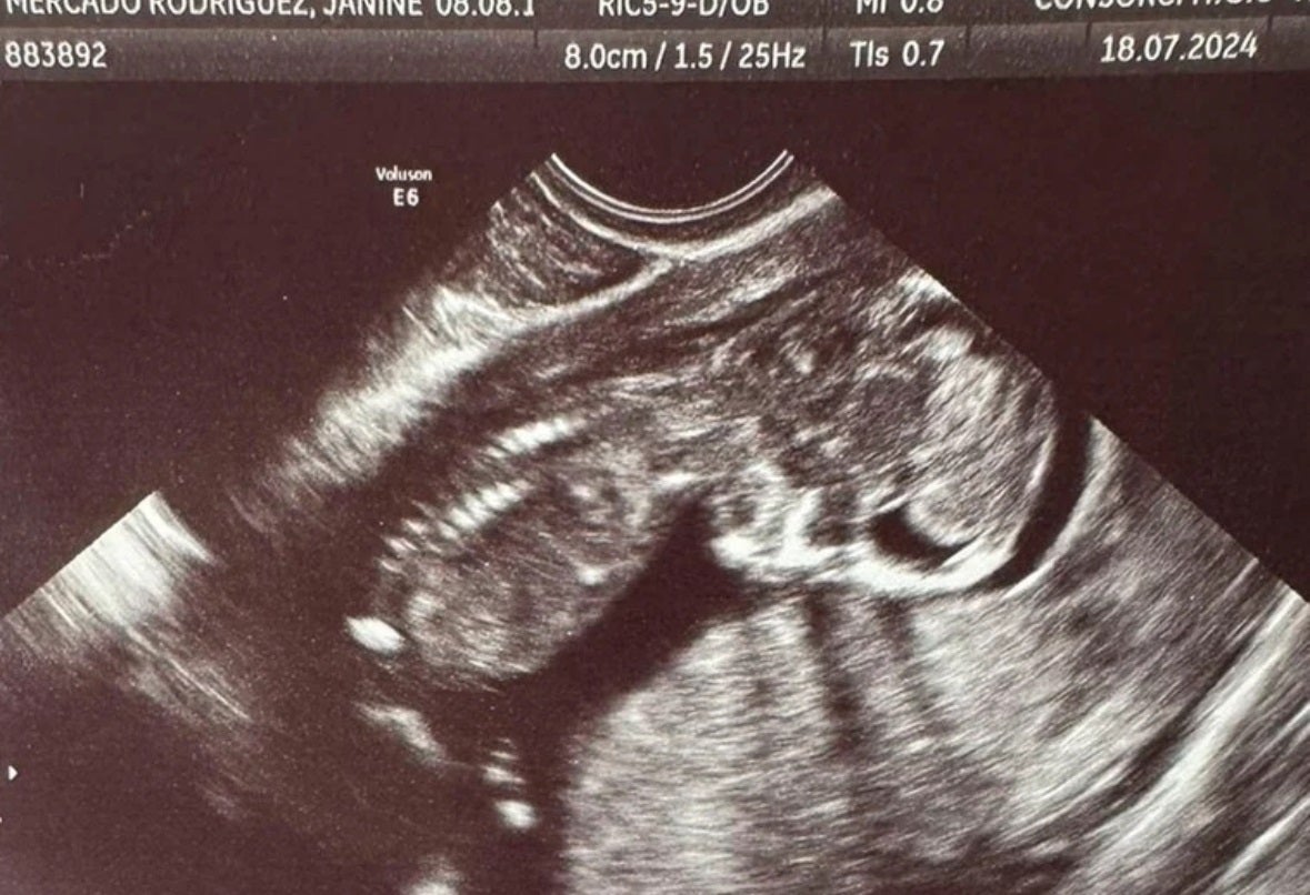Ecografía de la pequeña Escarlett facilitada por su abuela.