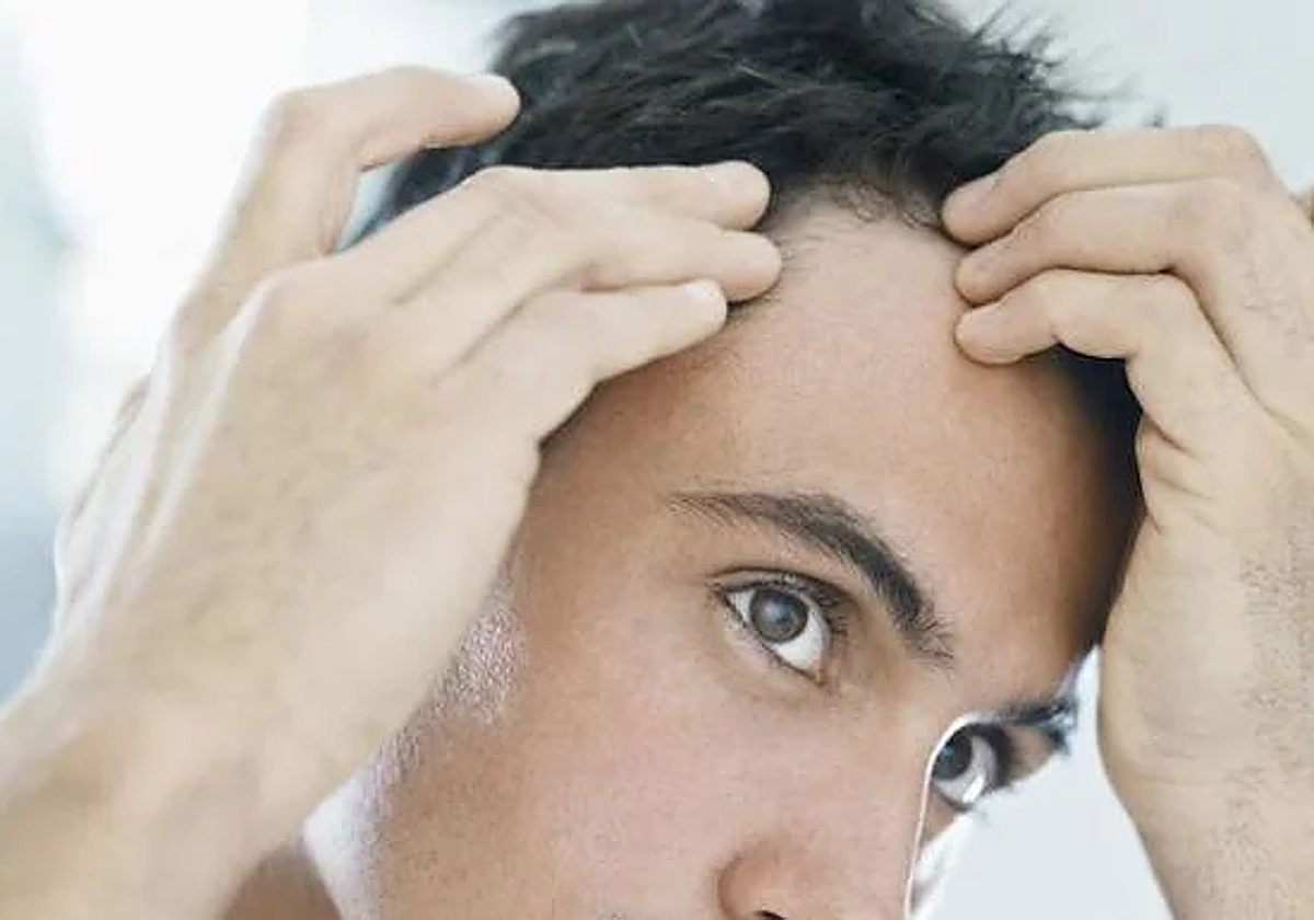 Caída del cabello en una imagen de archivo.