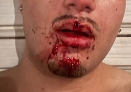 Uno de los jóvenes heridos en la reyerta tras recibir un botellazo en la cara.