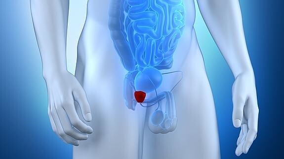 El sobrediagnóstico de cáncer de próstata alcanza el 75% de los casos