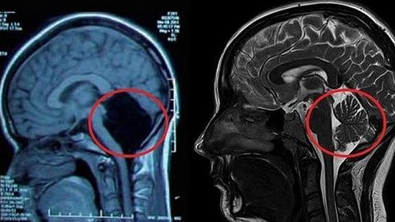 Comparación de la resonancia del cerebro de la paciente china con uno normal.