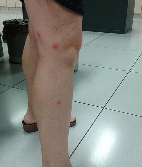 Efectos de las picaduras.