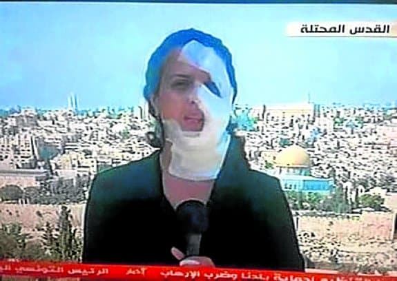Hana Mahameed fue herida en la cara.