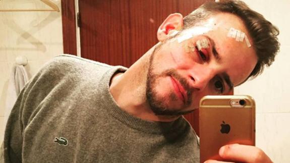 Álex Casademunt muestra sus heridas tras ser agredido