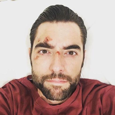 Dani Mateo explica qué le pasó en la cara