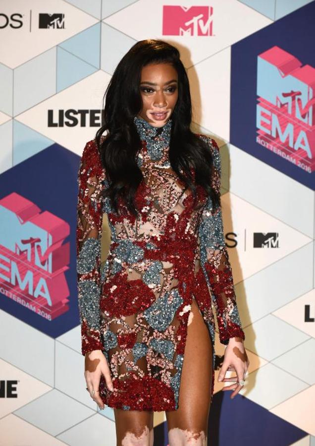 Winnie Harlow. 
