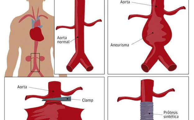 Así se interviene el aneurisma de aorta abdominal roto. 