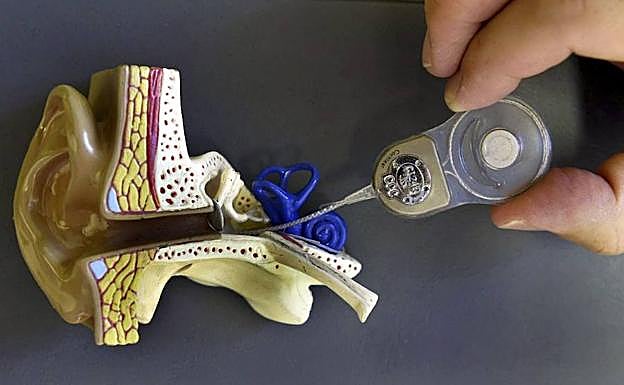 Implante coclear en una imagen de archivo. 