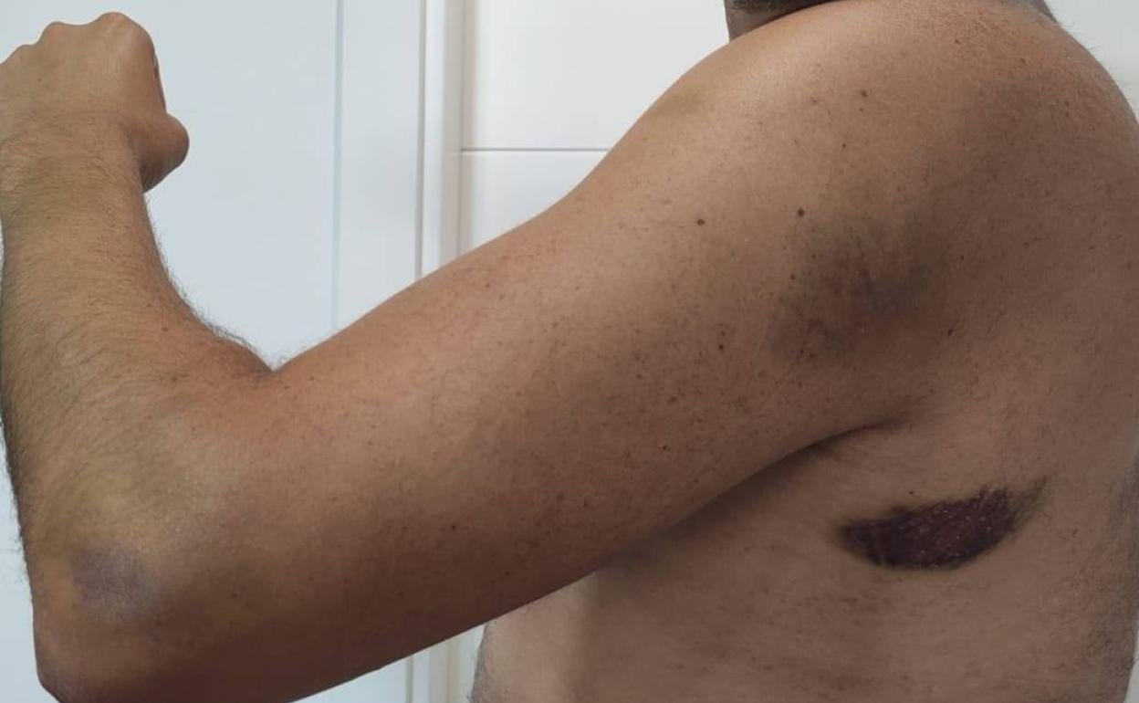 Heridas del sanitario agredido. 