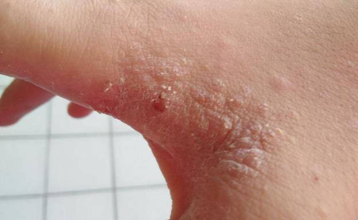 Infección por sarna: qué es y como tratarla