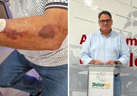 Lesiones sufridas por el vecino en un brazo y José Joaquín Hernández, alcalde de Dolores.