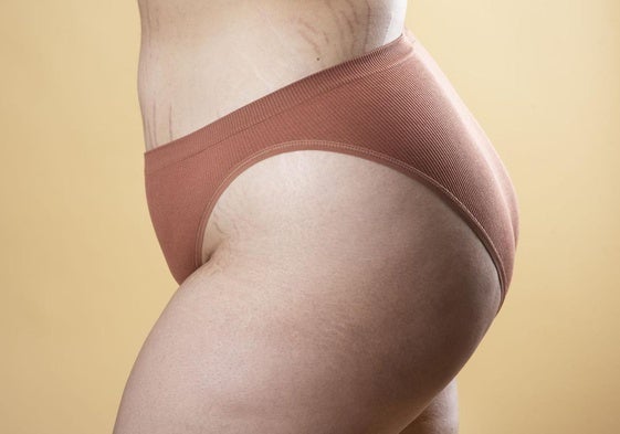 Cuerpo de una mujer con estrías.