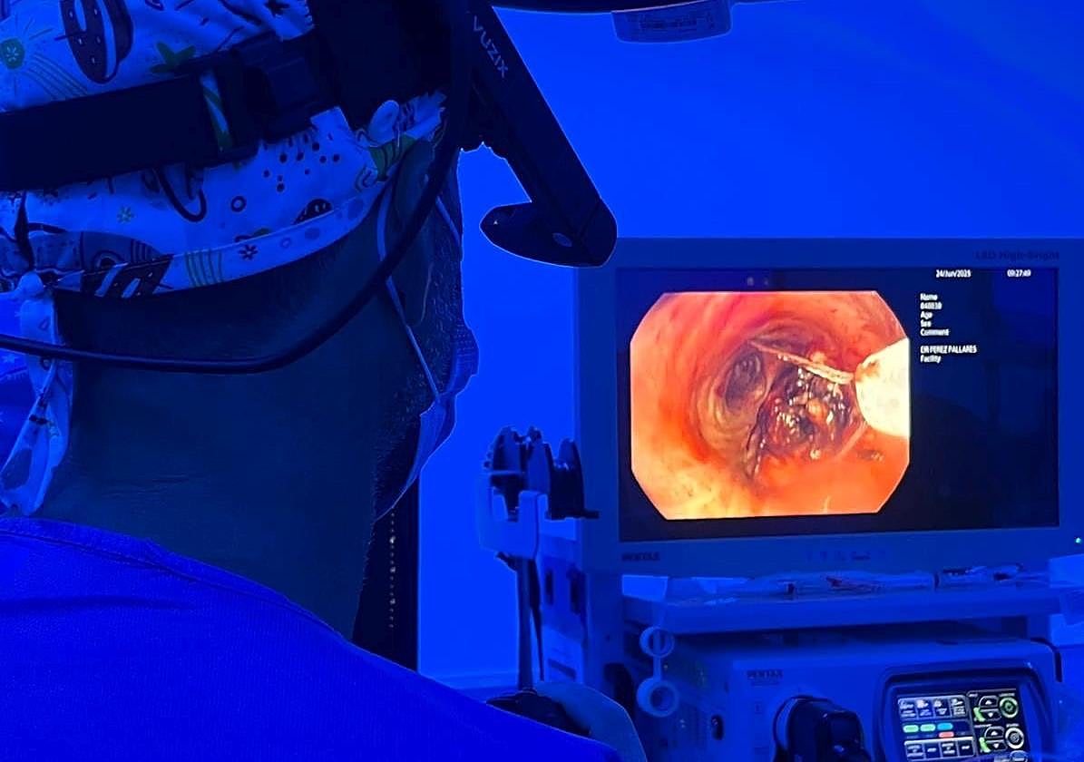 El hospital Santa Lucía es el segundo en Europa que emplea las microondas en lesiones centrales de pulmón.