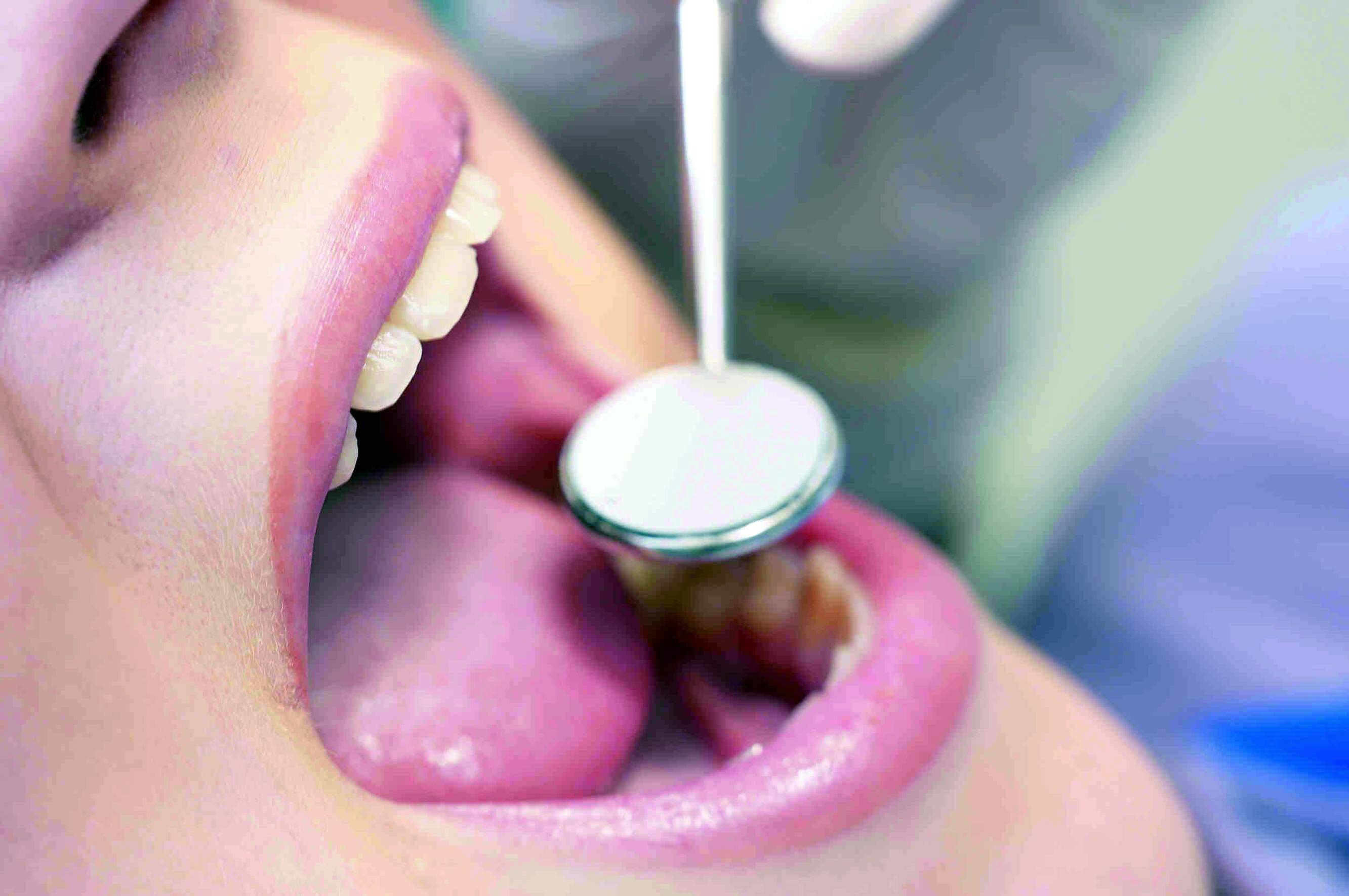 El peligro de los implantes dentales "low cost"