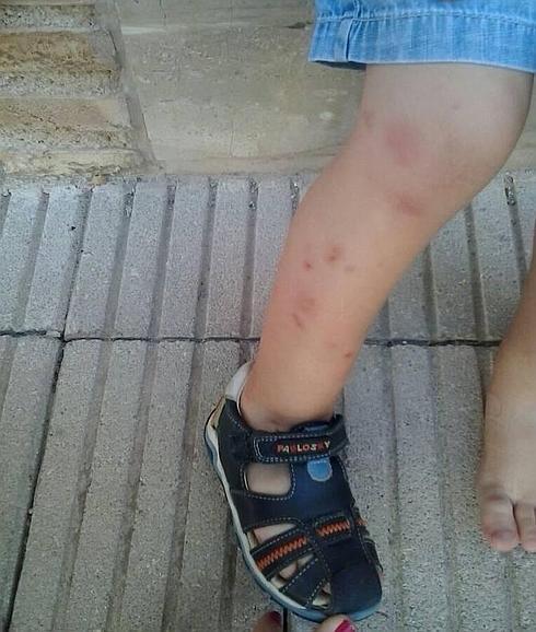 Picaduras de mosquito en la pierna de un menor del municipio que tuvo que ser atendido de urgencia por personal médico. 