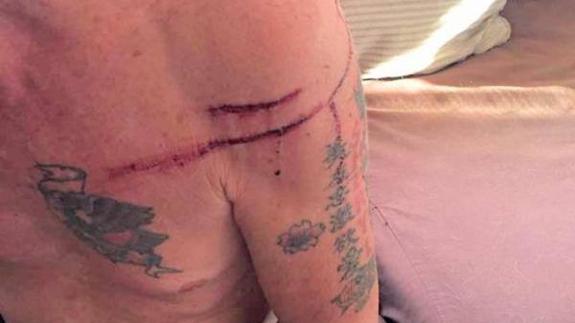 Atsushi Aoki muestra las heridas sufridas tras el ataque del oso. 