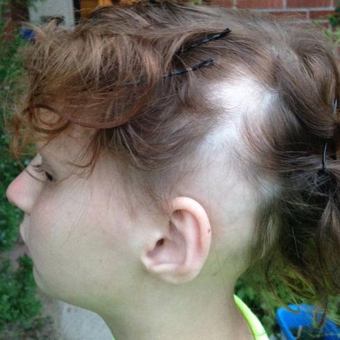 La niña, en la fotografía en la actualidad, ha recuperado parcialmente el cabello.