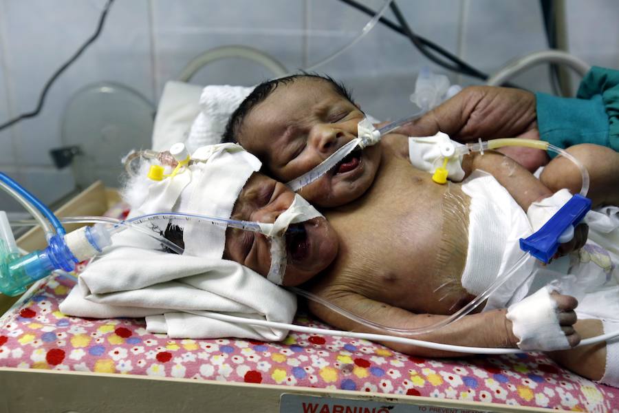Fotos: Nacen dos siameses en Yemen