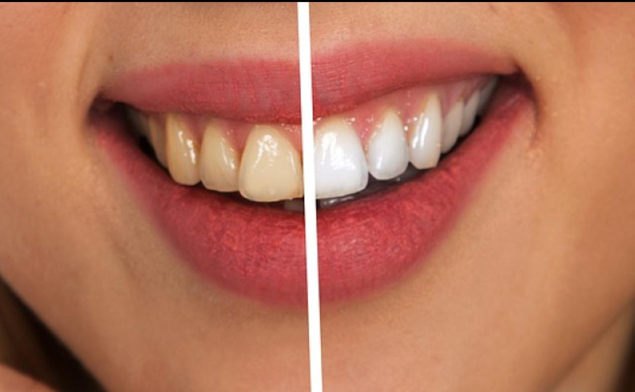 Los dentistas leoneses piden prudencia a la hora de someterse a los tratamientos blanqueadores. 