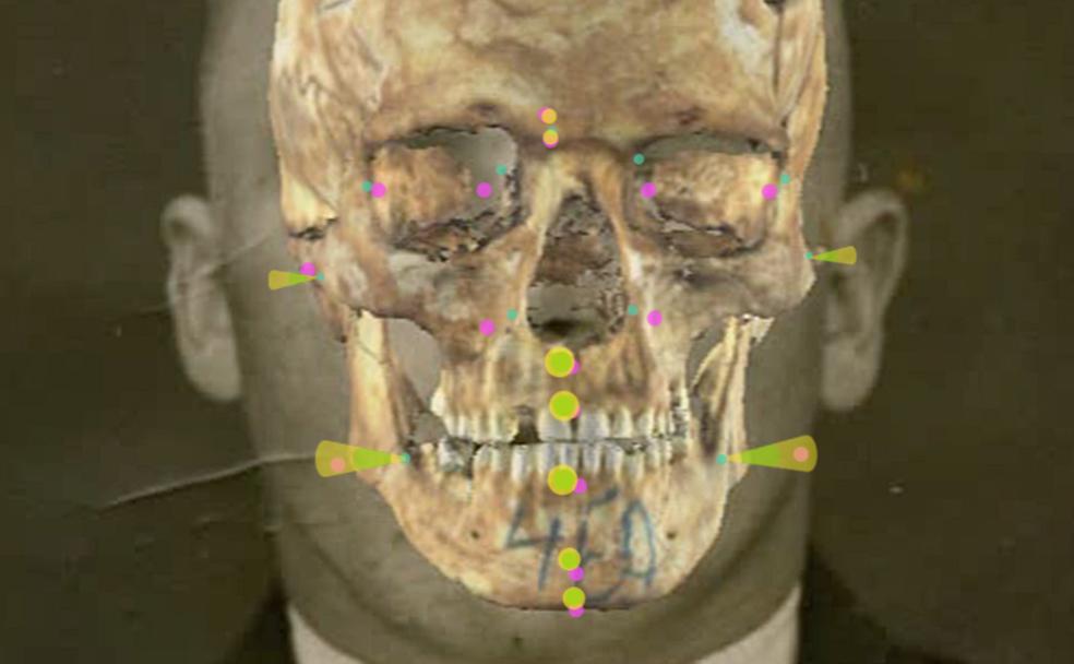 Superposciión cráneo-facial realizada con el software Skeleton-ID.