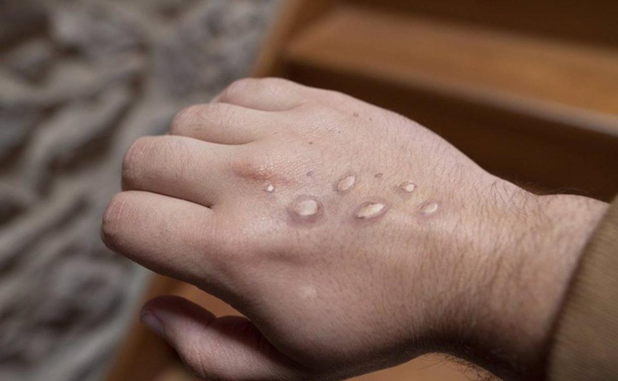 Un hombre muestra pústulas en la mano, uno de los síntomas habituales de la enfermedad.