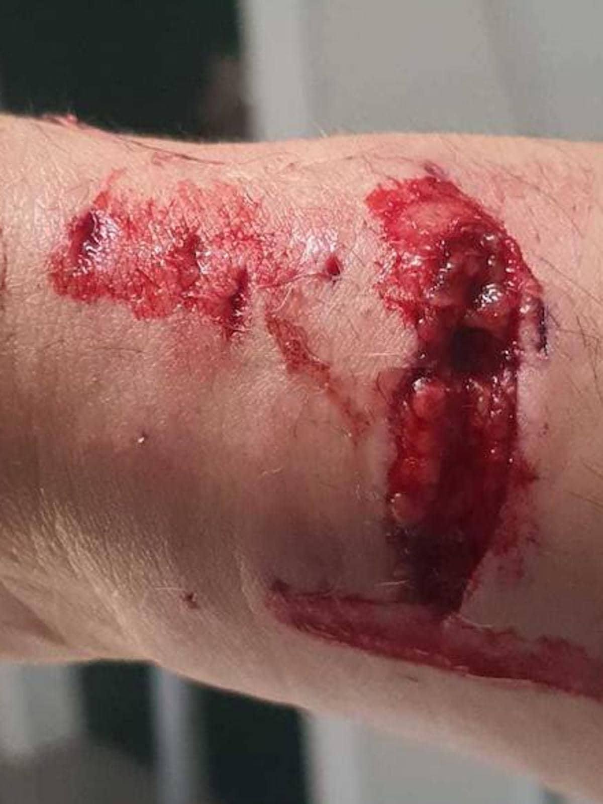 Heridas en el brazo del hombre provocadas por el ataque de los perros.