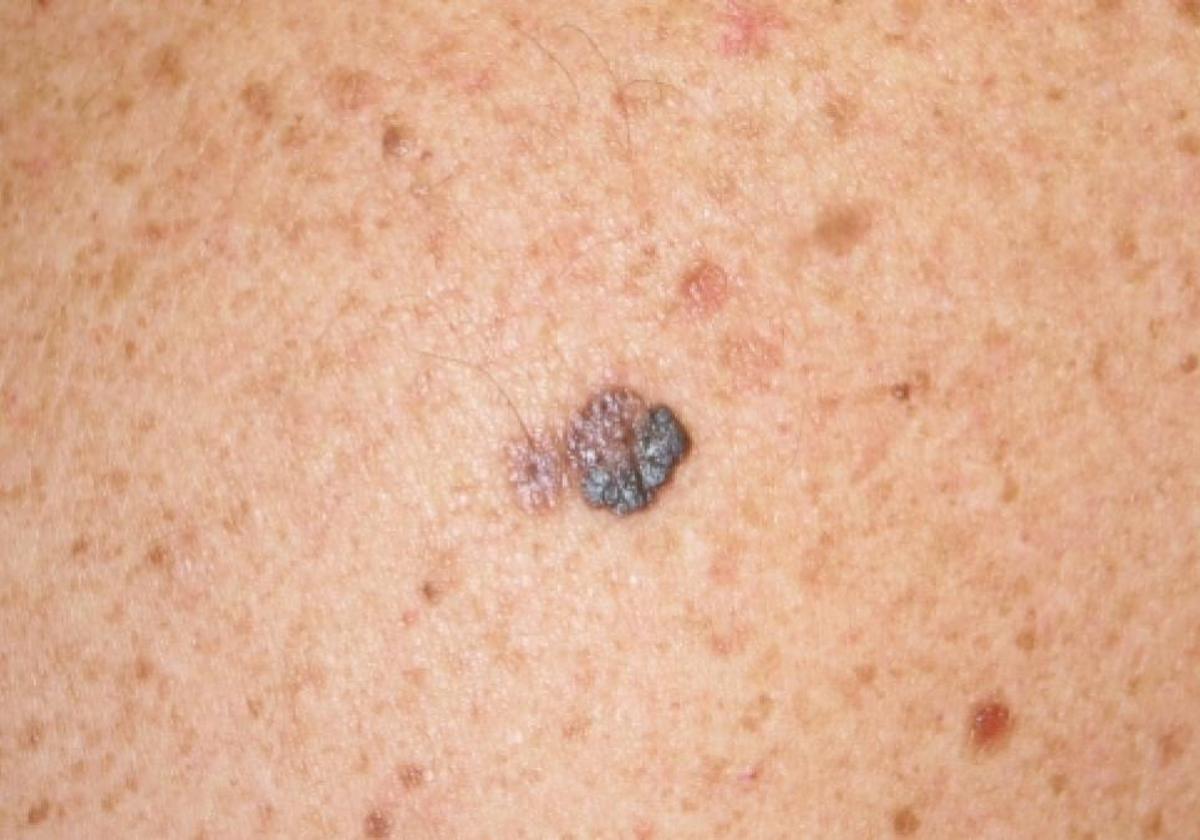 En la provincia de León se detecta un melanoma cada tres días. En lo que va de año, solo en el hospital de León, se han confirmado 41 casos.