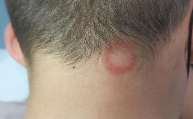 Los dermatólogos piden extremar las precauciones ante la presencia de casos de tiña. 