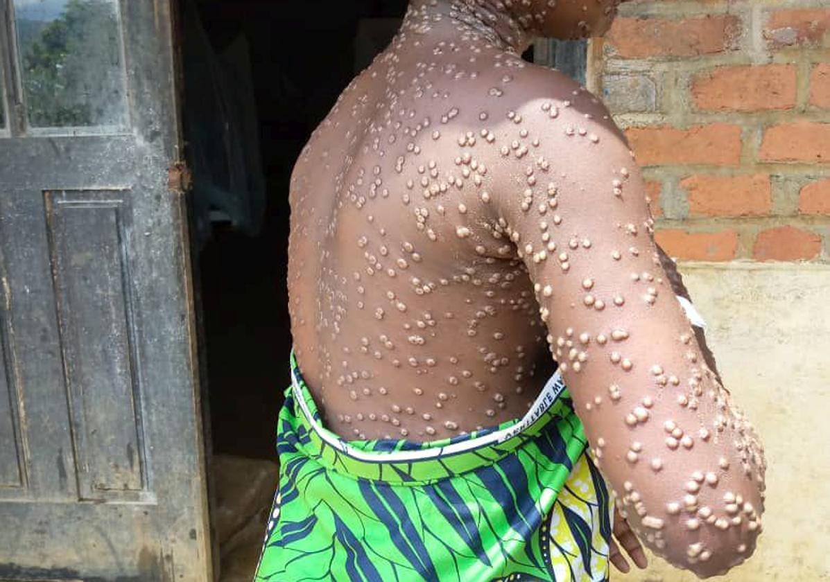 Una persona contagiada con mpox en el este de la República Democrática del Congo