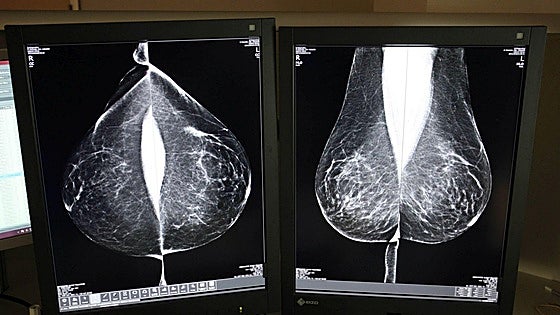 Sacyl externaliza de nuevo la doble lectura de mamografías para agilizar los tiempos
