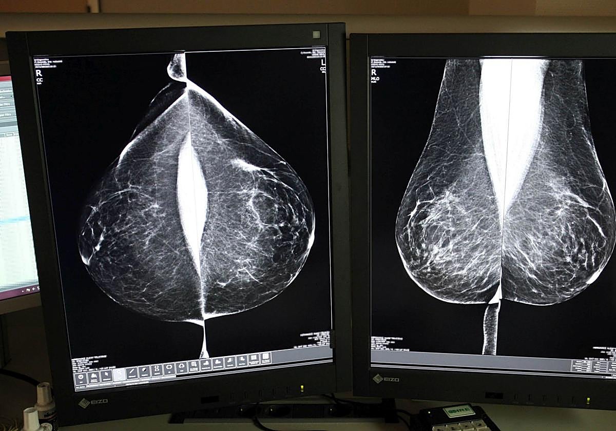 Estudio de una mamografía digital en el hospital de Valladolid.