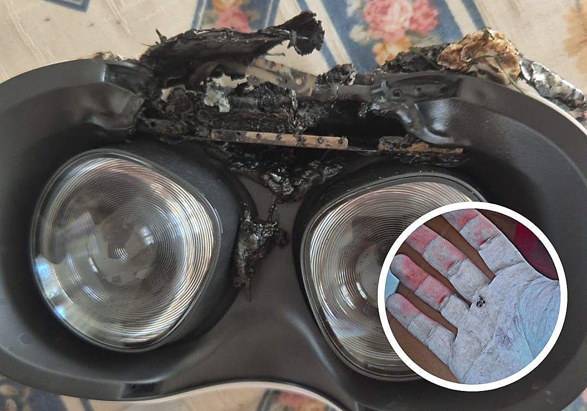 Las gafas de realidad virtual tras arder y una de las heridas causadas en la mano.
