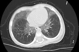Imagen secundaria 2 - Informes médicos en Salamanca y Madrid, y una imagen de unos pulmones de un paciente con enfermedad pulmonar por hiperplasia de células neuroendocrinas.