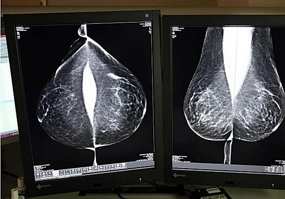 Mamografía para detectar un posible daño.