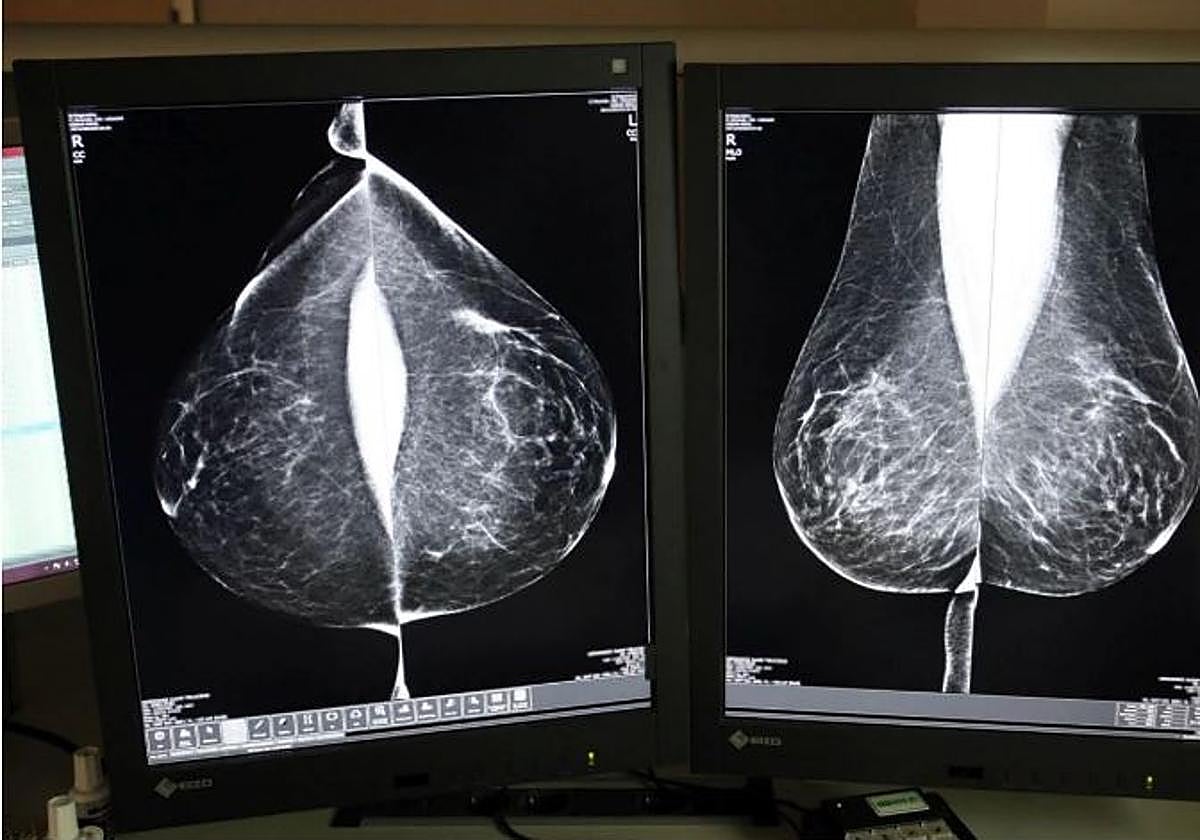 Mamografía para detectar un posible daño.